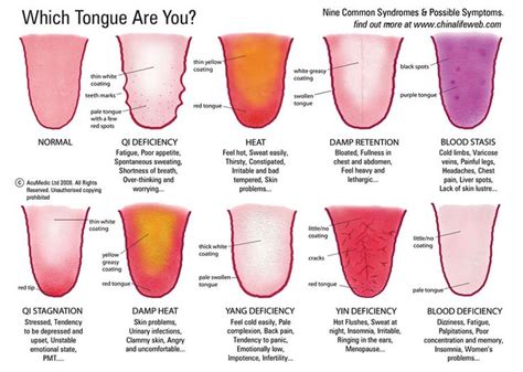 Tcm Tongue Diagnosis Tongue Health Chinese Medicine Traditional