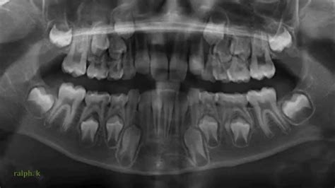 They also help them find and treat dental problems early. NEW TEETH X-RAY VIDEO - 8 Year old - YouTube