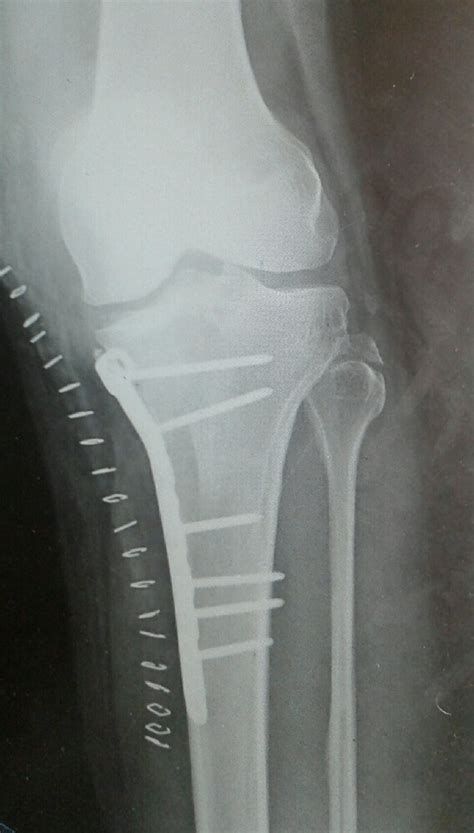 Medial Condyle Tibia Fracture With Plate