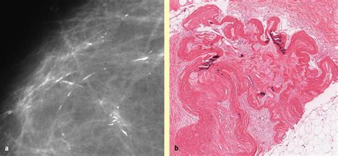 Benign Microcalcification And Its Differential Diagnosis In Breast Screening Diagnostic