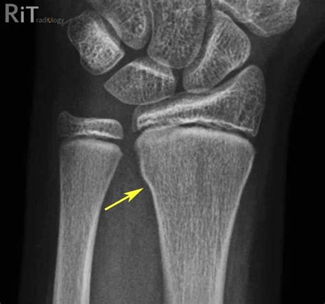 Rit Radiology Buckle Torus Fracture Of The Distal Forearm