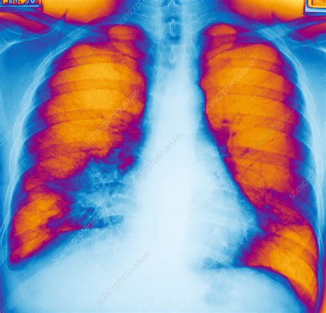 Epidemic Kaposis Sarcoma X Ray Stock Image M1120376 Science