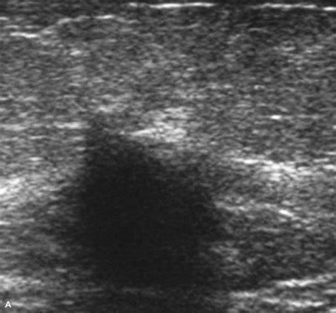 Posterior Acoustic Shadowing In Benign Breast Lesions Weinstein