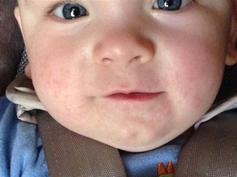Wheezing, a runny nose, red eyes and sneezing. Does this look like food allergy rash? (Pic) - BabyCenter