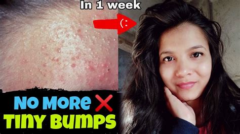 7 Days Challenge 😍treat Tiny Bumps On Foreheadsface Naturally100