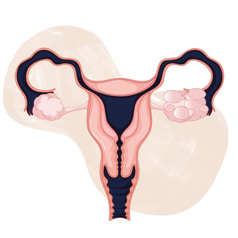 It is characterized by irregular menstrual periods, excess male hormones, and/or ovarian cysts. PCOS and pregnancy: Polycystic Ovary Syndrome and ...