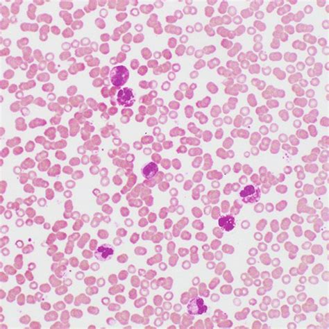 Peripheral Blood Smear Showing Many Dysplastic Eosinophils Wrights