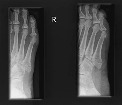 Fractures Of The Fifth Metatarsal Diagnosis And Treatment Injury