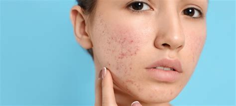 Acne And Rosacea Know The Difference Acne Treatment