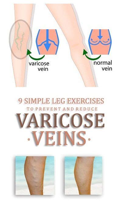 9 Best Exercises To Clear Varicose Veins Varicose Vein Remedy Varicose Veins Varicose Veins