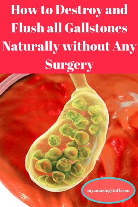 How To Destroy And Flush All Gallstones Naturally Without Any Surgery