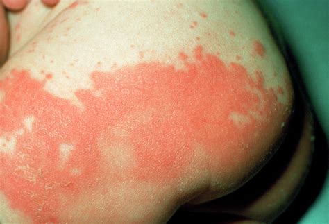 Candiasis Rash On Infants Buttocks Photograph By Science Photo Library