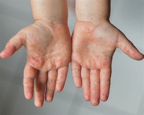 Hand Foot And Mouth Disease Hfmd Osler Health International