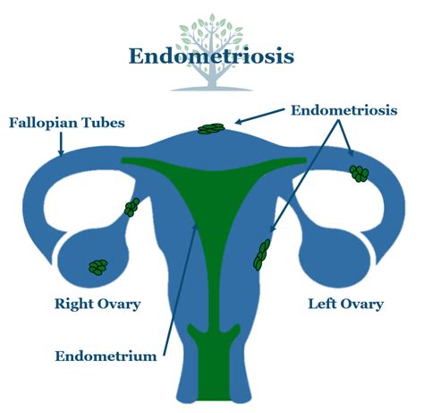 Endometriosis Generation Next Fertility Nyc