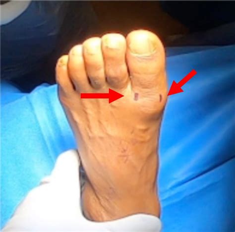 Hallux Rigidus Treatment Hip Arthroscopy And Foot And Ankle Surgery