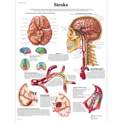 Stroke Symptoms Chart