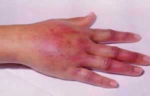 Antes de remover os cravos, lave bem suas mãos e rosto. QUEIMADURA DE TATURANA 06/4/15 | BICHOS,SAIAM DO LIXO ...