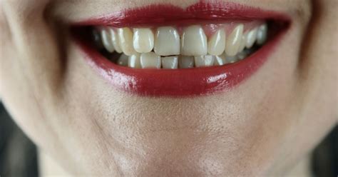 Dentists Warning Over Dangerous Tooth Flossing Trend On Tiktok Wales