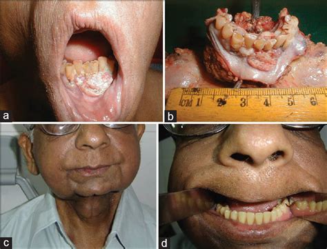 Stage 4 Mouth Cancer Life Expectancy Cancerwalls