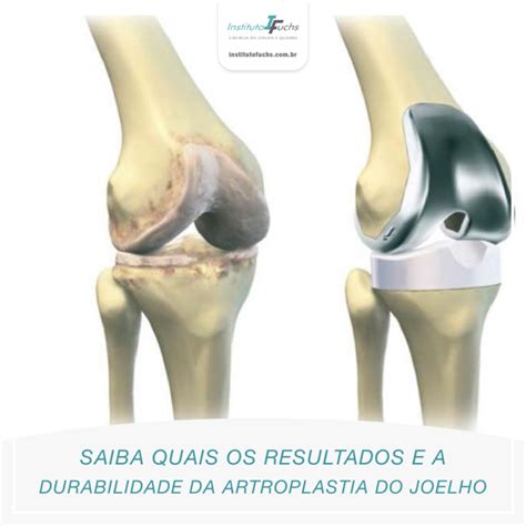 Saiba Quais Os Resultados E A Durabilidade Da Artroplastia Do Joelho