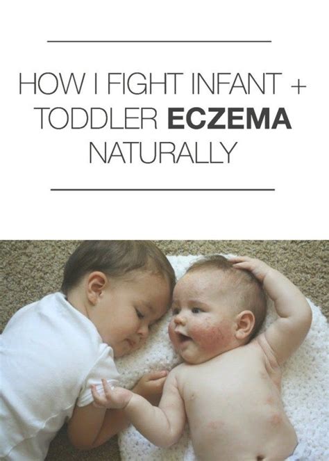 How I Fight Infant And Toddler Eczema And Cradle Cap With Images