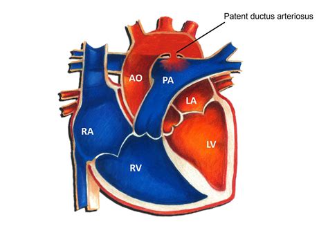 Patent Ductus Arteriosus Pediatric Heart Specialists
