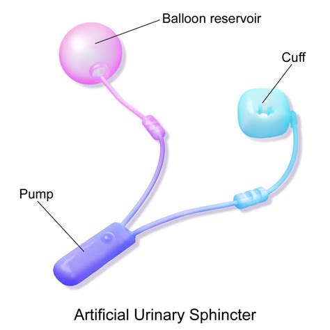 Artificial Urinary Sphincter Aus What You Need To Know Our
