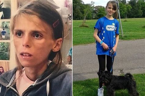 Anorexic Teenager Who Ate Just An Apple A Day Starved Herself Until Her