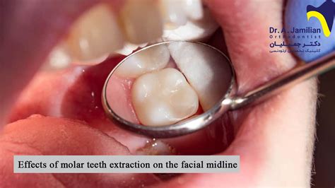 Effects Of Molar Teeth Extraction On The Facial Midline Dr Jamilian