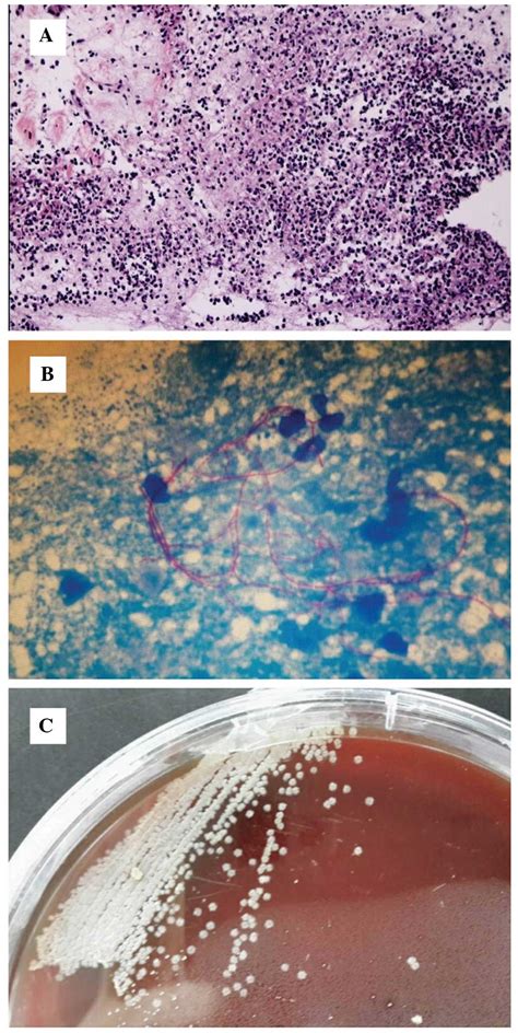 Disseminated Nocardiosis Caused By Nocardia Otitidiscaviarum In An