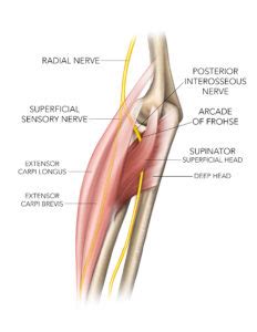 Uncommon injuries: Posterior interosseous nerve ...