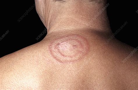 Ringworm Fungal Infection Stock Image C0465278 Science Photo Library
