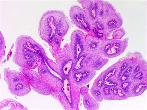 Pathology Outlines Sinonasal Papilloma