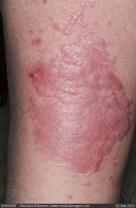 Stock Image Dermatology Severe Lichen Planus A Patch Of Purple Red