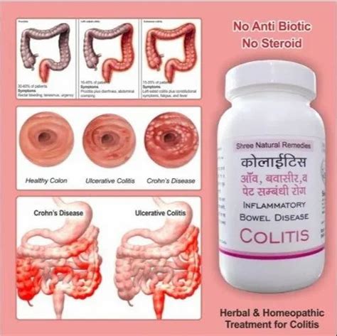Bowel Disease Colitis At Best Price In Meerut By Shree Natural Remedies