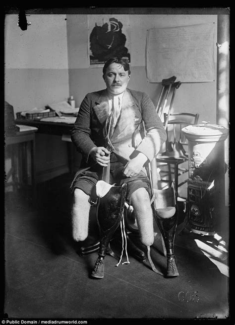Photos Of Artificial Limbs Given To World War I Veterans Daily Mail