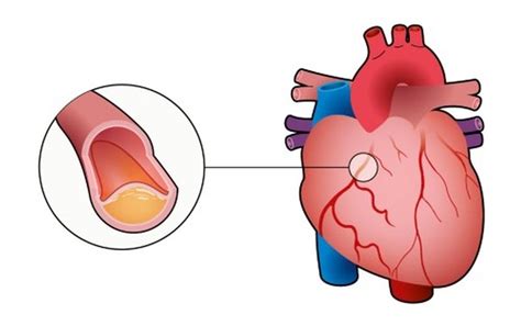 A Graphical Guide To Ischemic Heart Disease Scientific American