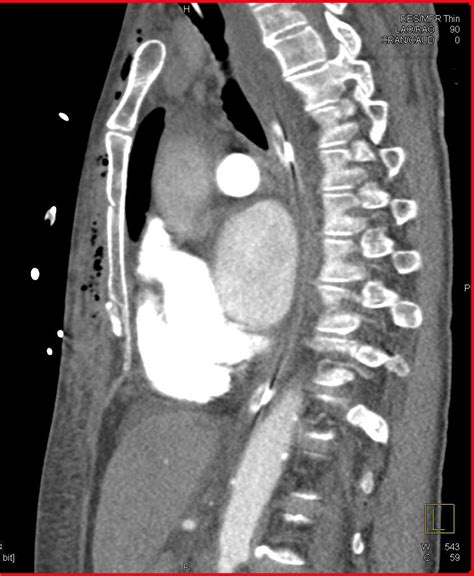 Trauma With Sternal Fracture And Air In The Chest Wall Trauma Case