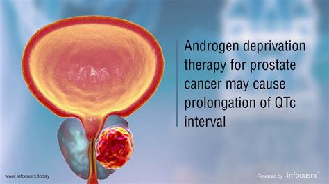 Androgen Deprivation Therapy For Prostate Cancer Causes Prolongation Of Qtc Interval Youtube