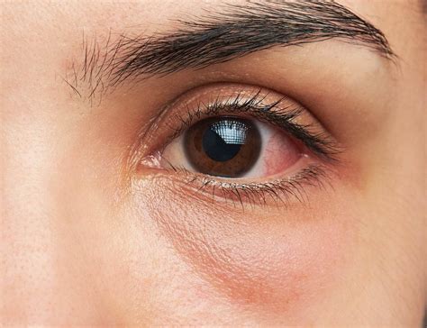 Penyebab Mata Berair Dan Cara Mengatasinya Viralnesia Riset