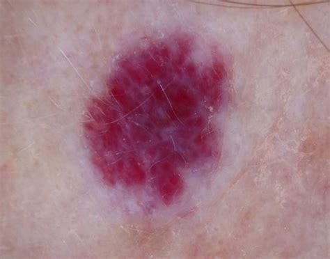 Cherry Angioma Pictures Removal Causes Home Treatment