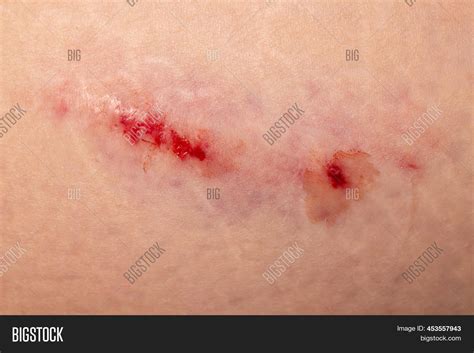 Bruise Large Bruise Image And Photo Free Trial Bigstock