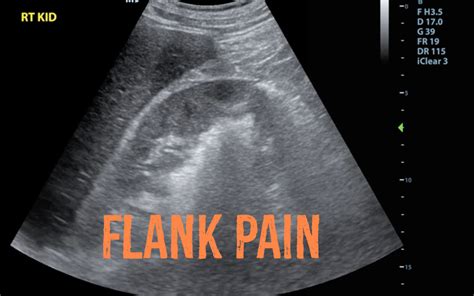 Hennepin Ultrasound Flank Pain
