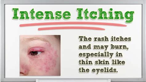Atopic Eczema Symptom Of Skin Rash Treatment Atopic Dermatitis Symptoms