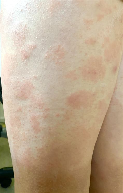 Are These Eczema Or Hives Or What Not Itchy But So Scary All Over