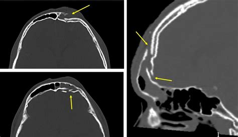 Frontal Bone Fracture And Frontal Sinus Injury Radiology Cases