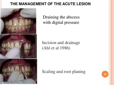 Periodontal Abscess