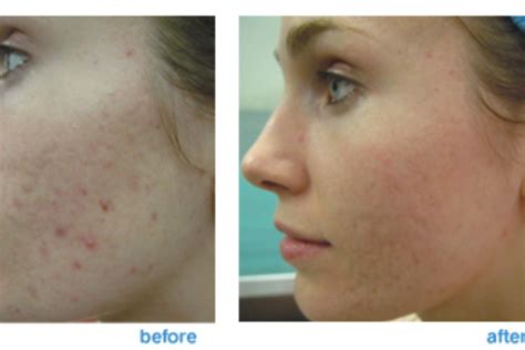 Acne Laser Scar Removal Before And After