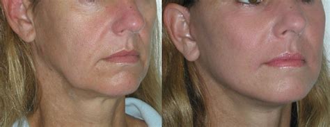 Stave Off And Eradicate Your Dual Chin Make Your Jaw Area Slimmer