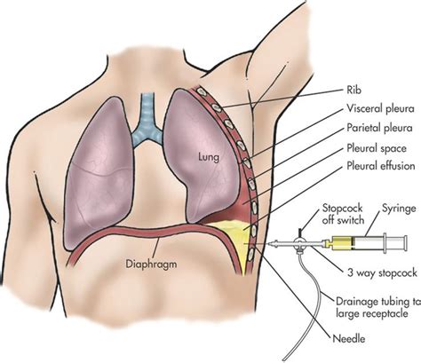 Pleuritis can be the cause of upper back pain when breathing deeply. Thoracentesis | Nursing notes, Emergency room nurse ...